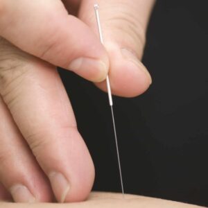 acupuncture needle in skin