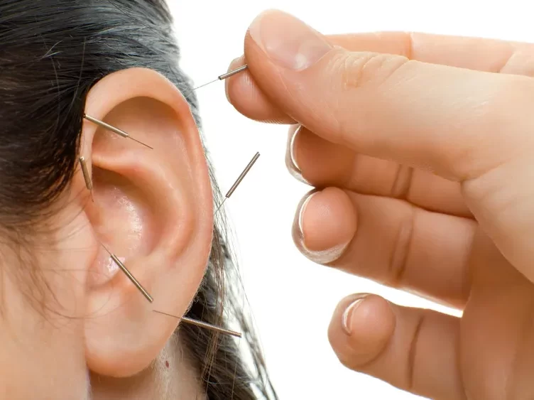 Hand performing auricular acupuncture