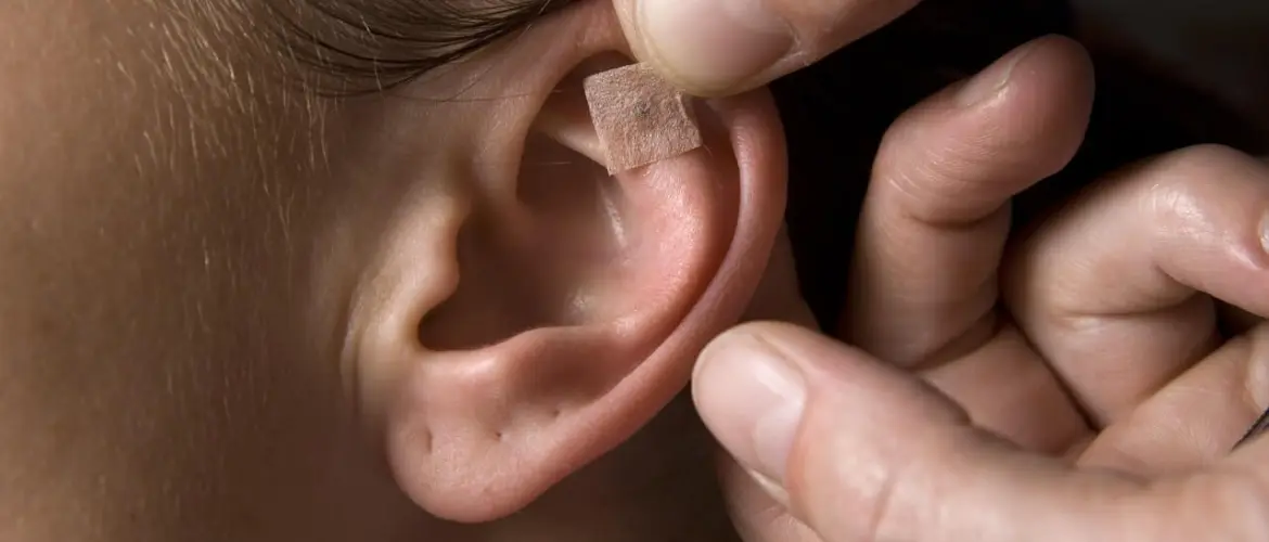 auriculotherapy magnetic ear seeds beads being applied to ear