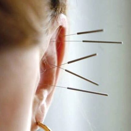 acupuncture needles in woman's ear